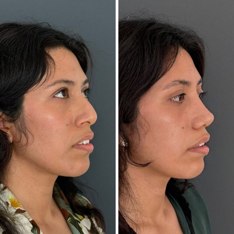 Rinoplastía - resultados - caso 01