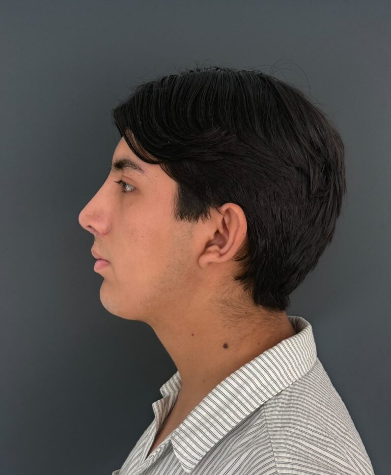 Rinoplastía masculina - caso 02