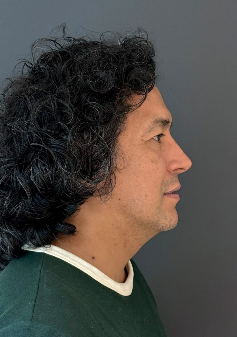 Rinoplastía masculina - caso 09