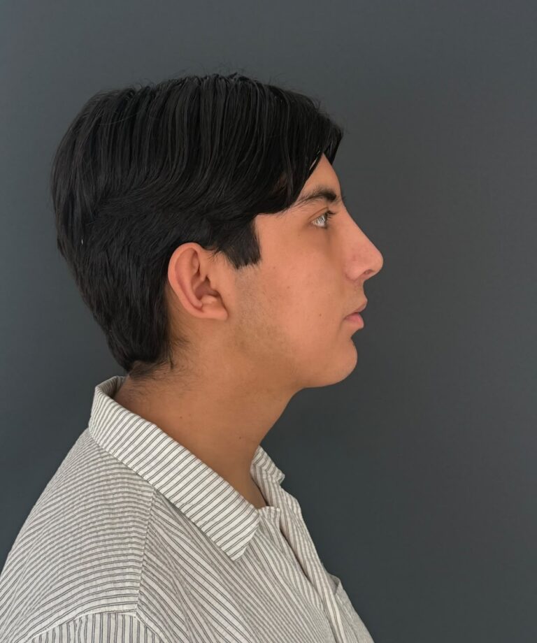 Rinoplastía masculina - caso 13